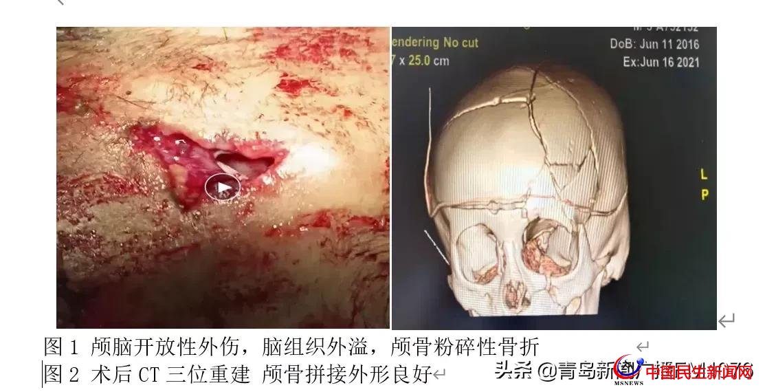 5歲男童6樓墜落命懸一線，婦兒醫(yī)院多學科協(xié)作再勝“死神”